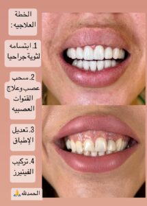 بعد الخطة التجميلية للثة والاسنان وتركيب الفينيرز